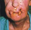 tobacco_mouth_cancer.webp