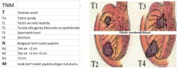 Testis Tümörü