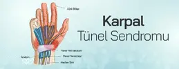 karpal-tunel-sendromu.webp